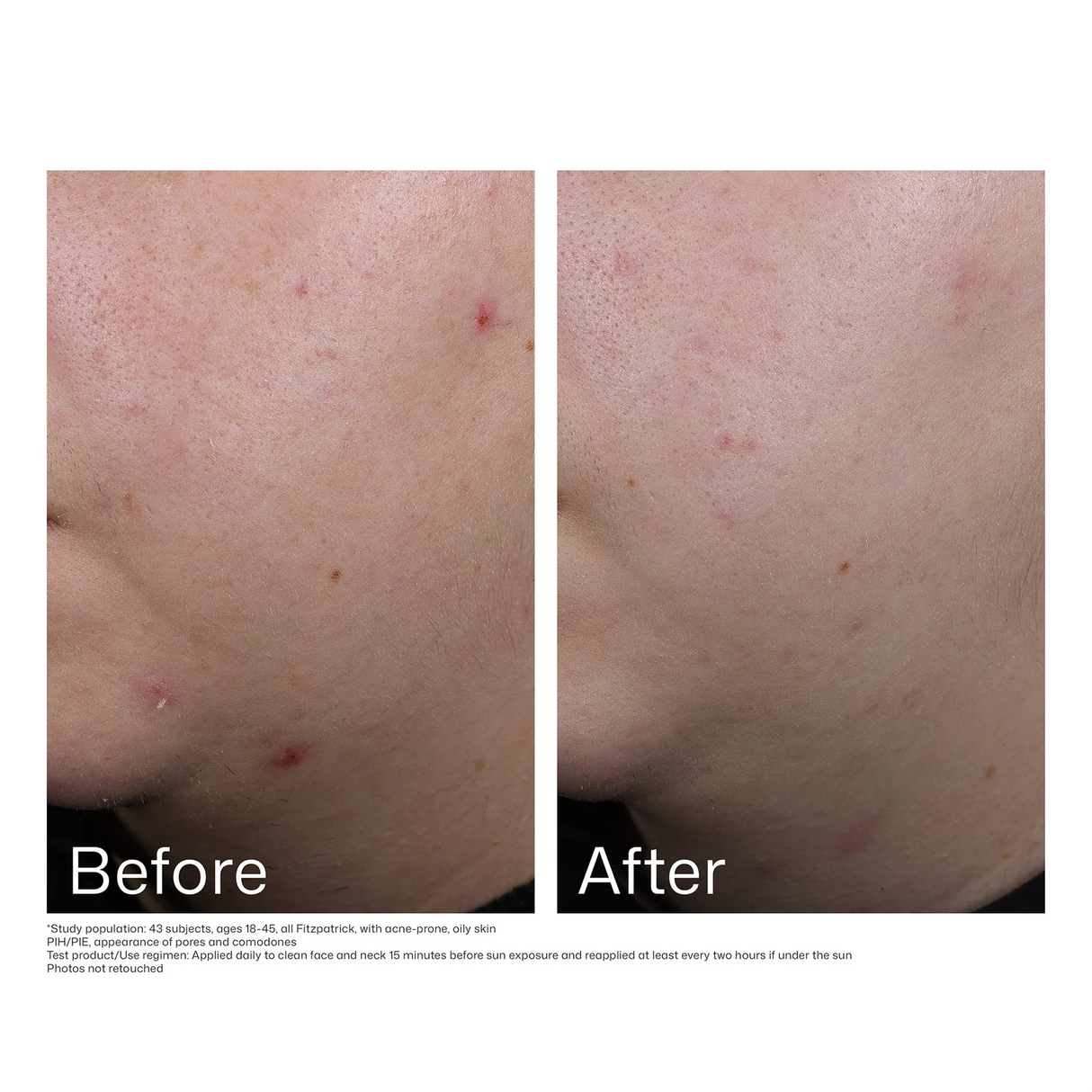 EltaMD® UV Clear Blemish-Prone & Oil Balancing SPF 50 - 1.7 fl. oz. / 48 g