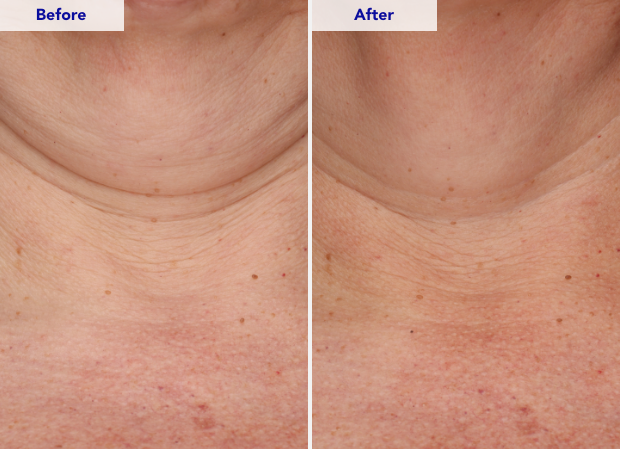 ZO® SKIN HEALTH Neck Complex Anti-Aging + Brightening Serum - 50mL/ 1.7 Fl. Oz.