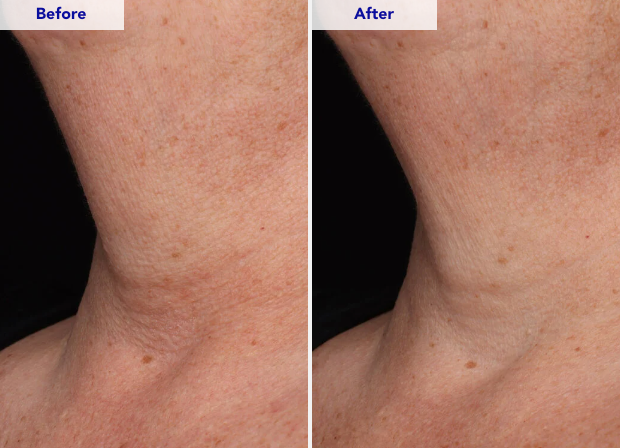 ZO® SKIN HEALTH Neck Complex Anti-Aging + Brightening Serum - 50mL/ 1.7 Fl. Oz.