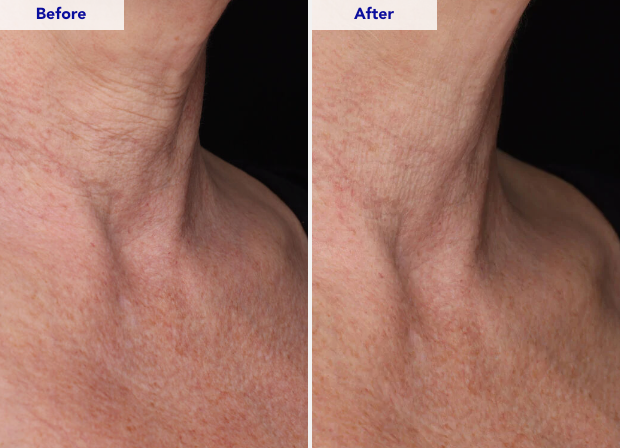 ZO® SKIN HEALTH Neck Complex Anti-Aging + Brightening Serum - 50mL/ 1.7 Fl. Oz.