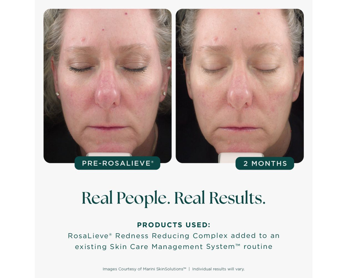 Marini SkinSolutions™ RosaLieve® Redness Reducing Complex - 1 fl. oz. (Clearance)