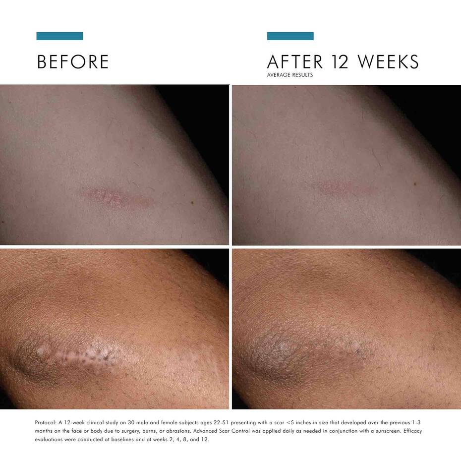 SkinCeuticals ADVANCED SCAR CONTROL