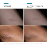 SkinCeuticals ADVANCED SCAR CONTROL