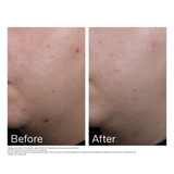 EltaMD® UV Clear Blemish-Prone & Oil Balancing SPF 50  - 1.7 fl. oz. / 48 g